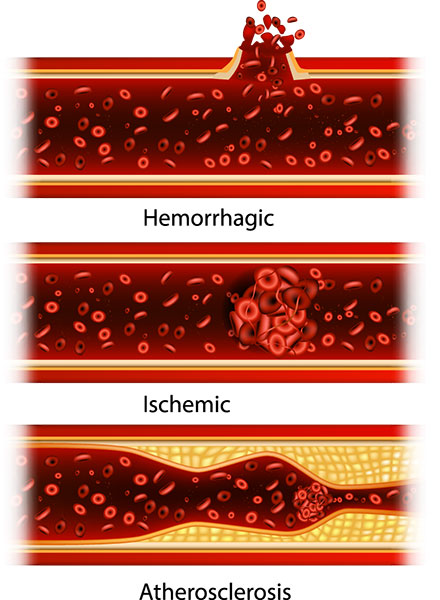 Types-of-stroke-Atherosclerosis-Ischemic-Hemorrhagic