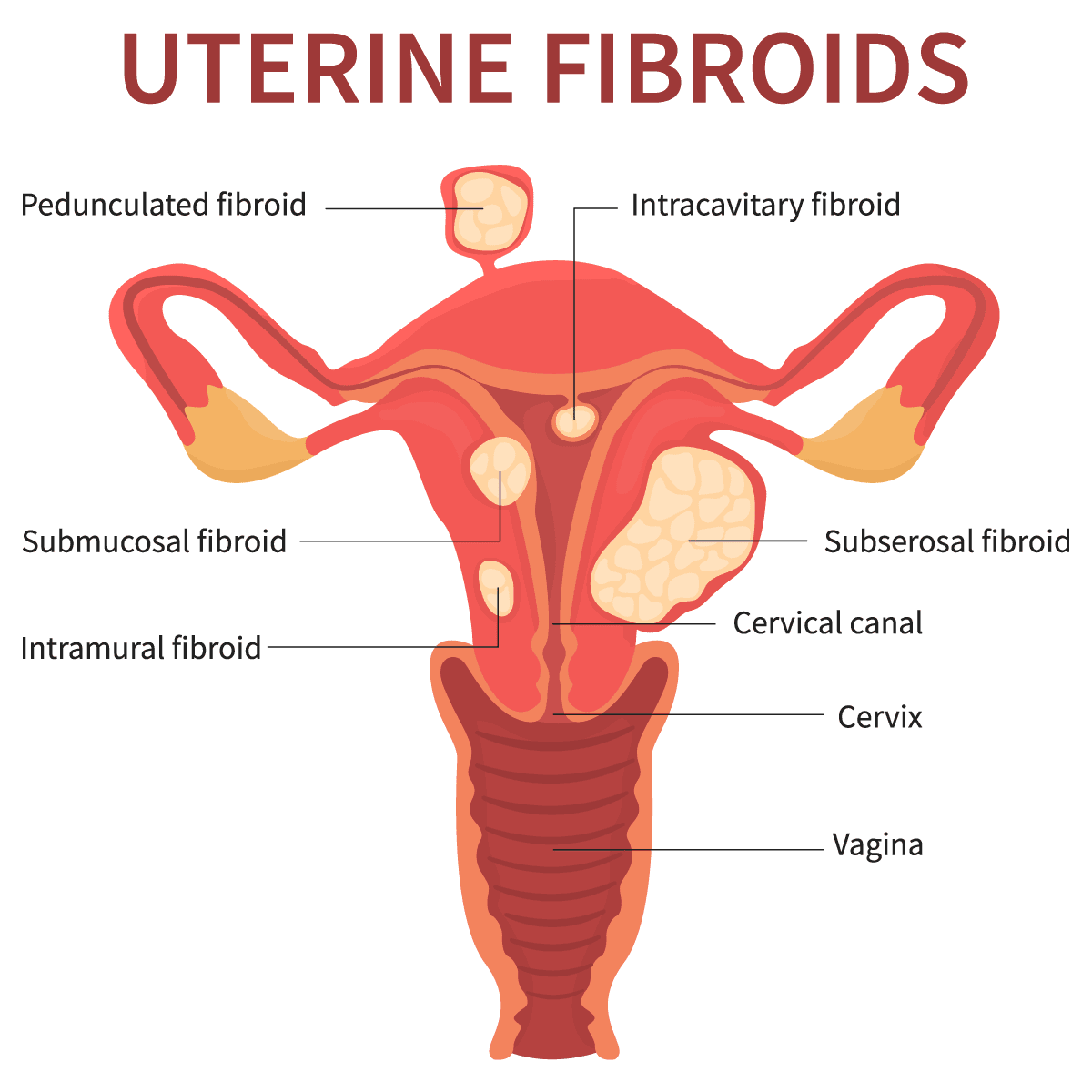 Treating Uterine Fibroid Embolization Ufe Without Surgery