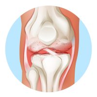Arthritis-of-the-human-knee-joint-475886967_5232x3177-[Converted]