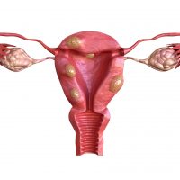 uterine-fibroid-are-benign-solid-tumors-formed-by-muscle-tissue.-Its-size-can-vary-greatly-and-some-cause-large-abdomen-increase-1153765292_3508x2480-min